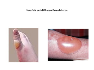 Superficial partial thickness (Second degree)
 