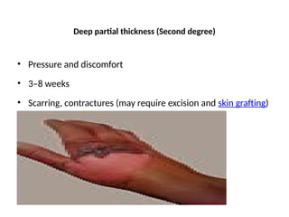 Deep partial thickness (Second degree)
• Pressure and discomfort
• 3–8 weeks
• Scarring, contractures (may require excision and skin grafting)
 