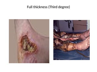 Full thickness (Third degree)
 