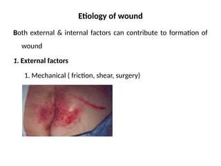 Etiology of wound
Both external & internal factors can contribute to formation of
wound
1. External factors
1. Mechanical ( friction, shear, surgery)
 
