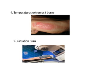 4. Temperatures extremes ( burns
5. Radiation Burn
 