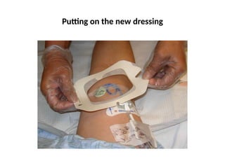 Putting on the new dressing
 