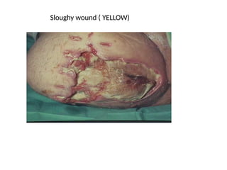 Sloughy wound ( YELLOW)
 