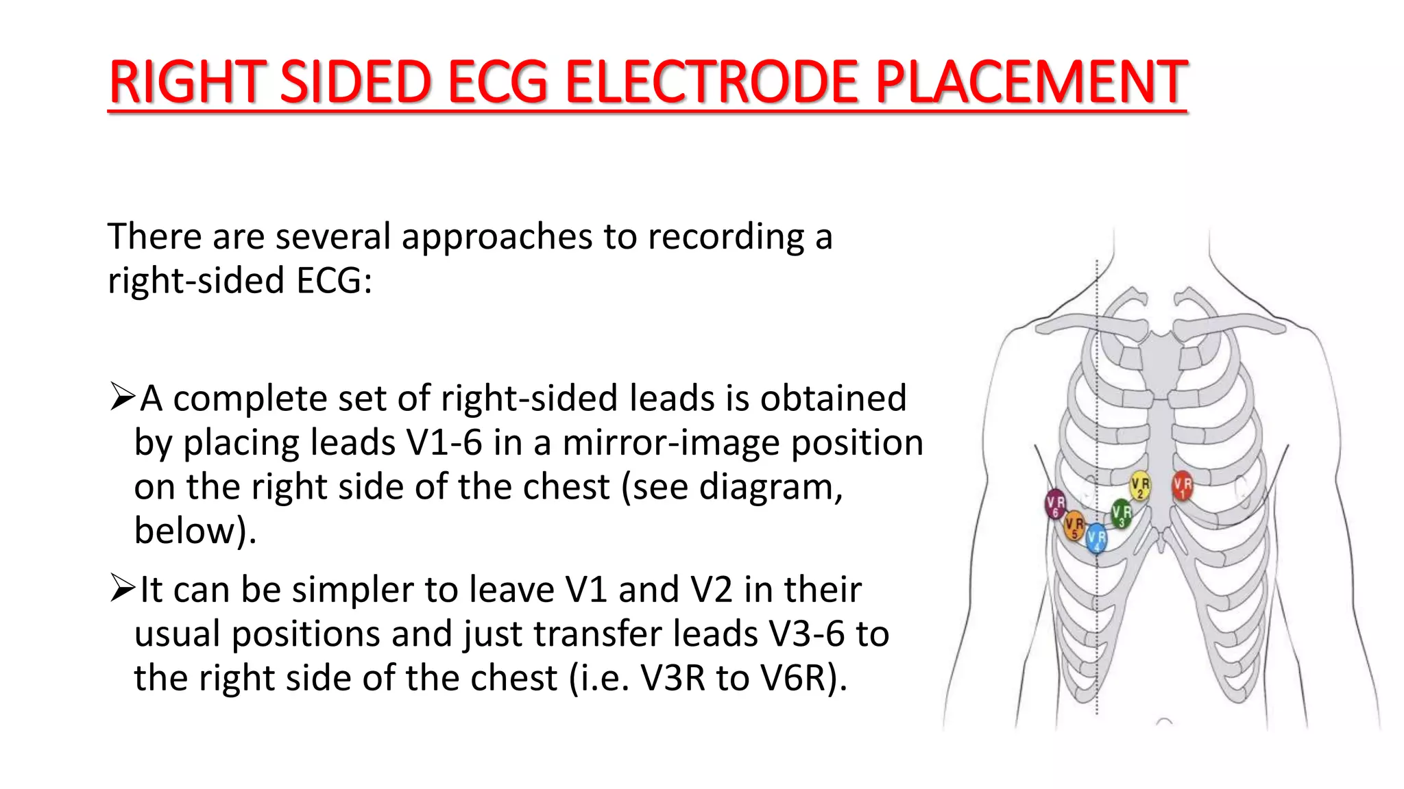 RIGHT SIDED ECG ELECTRODE PLACEMENT
There are several approaches to recording a
right-sided ECG:
A complete set of right-sided leads is obtained
by placing leads V1-6 in a mirror-image position
on the right side of the chest (see diagram,
below).
It can be simpler to leave V1 and V2 in their
usual positions and just transfer leads V3-6 to
the right side of the chest (i.e. V3R to V6R).
 