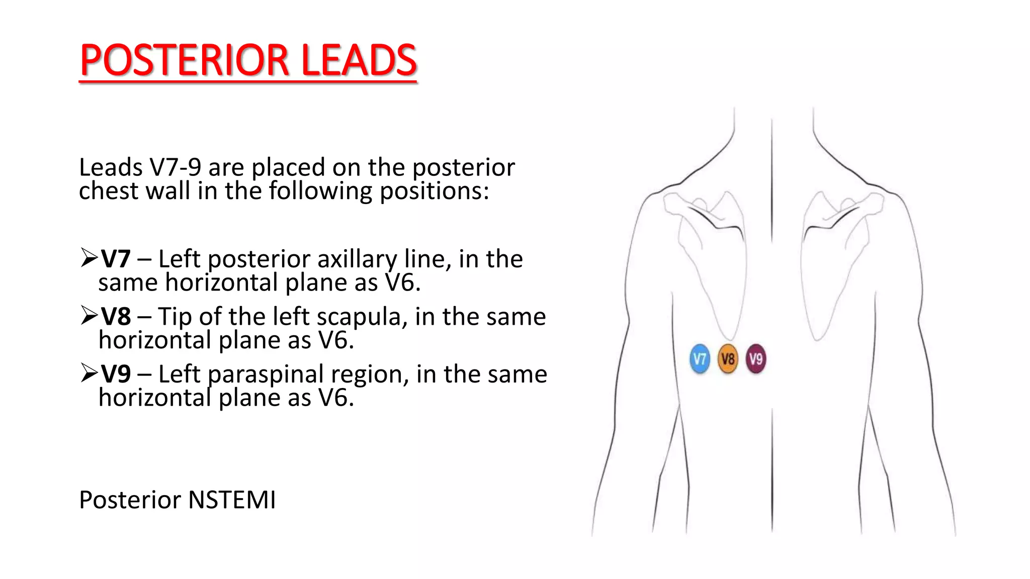 POSTERIOR LEADS
Leads V7-9 are placed on the posterior
chest wall in the following positions:
V7 – Left posterior axillary line, in the
same horizontal plane as V6.
V8 – Tip of the left scapula, in the same
horizontal plane as V6.
V9 – Left paraspinal region, in the same
horizontal plane as V6.
Posterior NSTEMI
 