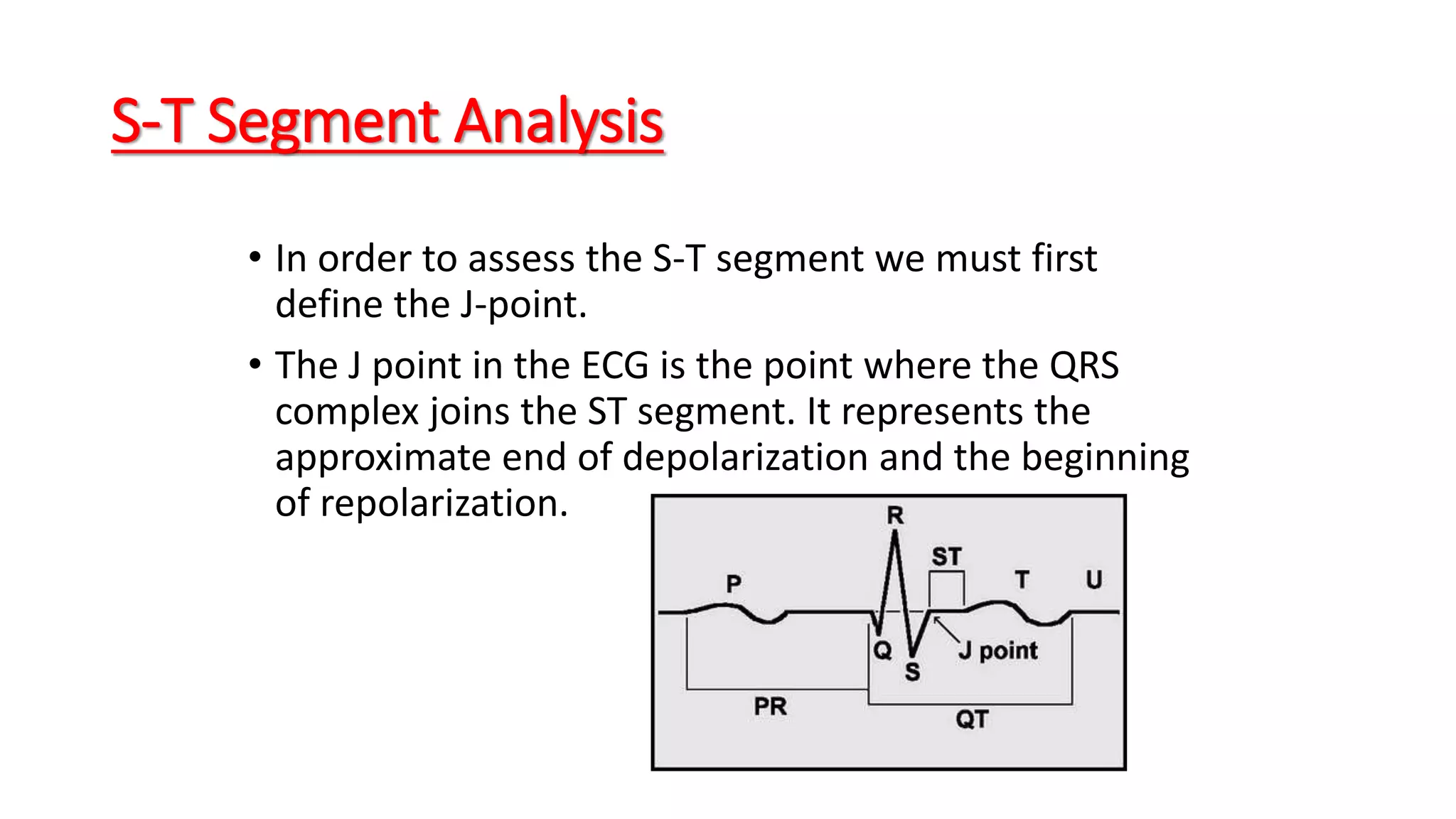 S-T Segment Analysis
• In order to assess the S-T segment we must first
define the J-point.
• The J point in the ECG is the point where the QRS
complex joins the ST segment. It represents the
approximate end of depolarization and the beginning
of repolarization.
 