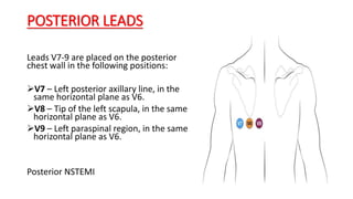 POSTERIOR LEADS
Leads V7-9 are placed on the posterior
chest wall in the following positions:
V7 – Left posterior axillary line, in the
same horizontal plane as V6.
V8 – Tip of the left scapula, in the same
horizontal plane as V6.
V9 – Left paraspinal region, in the same
horizontal plane as V6.
Posterior NSTEMI
 