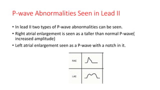 P-wave Abnormalities Seen in Lead II
• In lead II two types of P-wave abnormalities can be seen.
• Right atrial enlargement is seen as a taller than normal P-wave(
increased amplitude)
• Left atrial enlargement seen as a P-wave with a notch in it.
 
