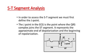 S-T Segment Analysis
• In order to assess the S-T segment we must first
define the J-point.
• The J point in the ECG is the point where the QRS
complex joins the ST segment. It represents the
approximate end of depolarization and the beginning
of repolarization.
 