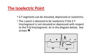 The Isoelectric Point
• S-T segments can be elevated, depressed or isoelectric.
• The J-point is deemed to be isoelectric if the S-T
line/segment is not elevated or depressed with respect
to the P-Q line/segment. As in the diagram below. See
arrows 


 