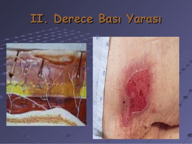 Yatak Yarasi Ne Kadar Surede Iyilesir