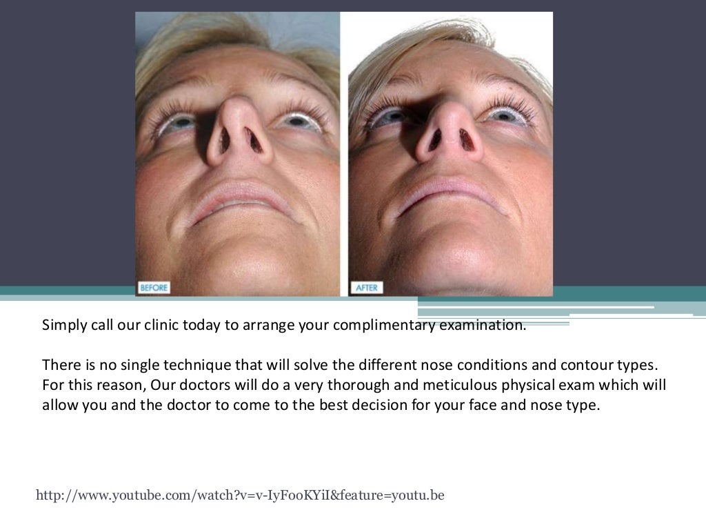 Baton rouge’s nose job from the best rhinoplasty doctor