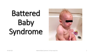 Battered
Baby
Syndrome
05-06-2023 Battered Baby Syndrome Dr. Nani Gopal Das 1
 