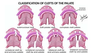 COMPREHENSIVE MANAGEMENT OF CLEFTS OF THE FACE LIPS,NOSE AND PALATE | PPTX