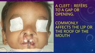 COMPREHENSIVE MANAGEMENT OF CLEFTS OF THE FACE LIPS,NOSE AND PALATE | PPTX
