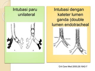Intubasi paru
unilateral
Crit Care Med 2000;28:1642-7
Intubasi dengan
kateter lumen
ganda (double
lumen endotracheal
tubes)
 