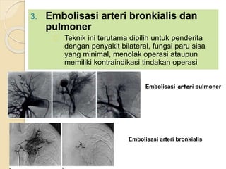 3. Embolisasi arteri bronkialis dan
pulmoner
Teknik ini terutama dipilih untuk penderita
dengan penyakit bilateral, fungsi paru sisa
yang minimal, menolak operasi ataupun
memiliki kontraindikasi tindakan operasi
Embolisasi arteri pulmoner
Embolisasi arteri bronkialis
 