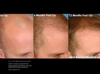 Temporal Point Hair Transplant Results including male, female, eyelash, eyebrow, scalp ...