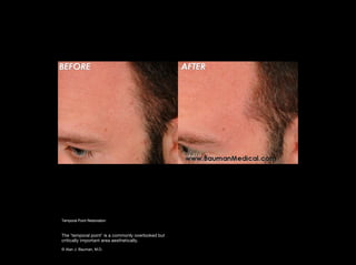 Temporal Point Hair Transplant Results including male, female, eyelash, eyebrow, scalp ...