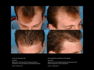 Temporal Point Hair Transplant Results including male, female, eyelash, eyebrow, scalp ...