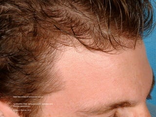Temporal Point Hair Transplant Results including male, female, eyelash, eyebrow, scalp ...