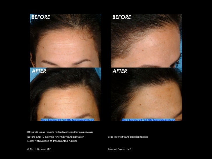 hair transplant results including male female eyelash hair transplant results including male female eyelash