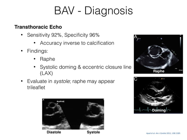 Bicuspid Aortic Valve And Aortopathy
