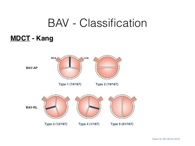 tavr bicuspid aortic valve Bicuspid Aortic Valve and Aortopathy tavr bicuspid aortic valve Bicuspid Aortic Valve and Aortopathy