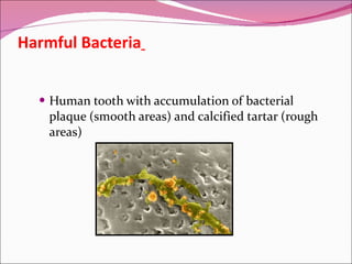   Harmful Bacteria   Human tooth with accumulation of bacterial plaque (smooth areas) and calcified tartar (rough areas) 