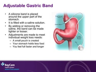 Adjustable Gastric Band A silicone   band is placed around the upper part of the stomach. It is filled with a saline solution.  By adding or removing the saline, the band can be made tighter or looser. Adjustments are made to meet individual weight loss needs: A small pouch is created Your stomach holds less food You feel full faster and longer 
