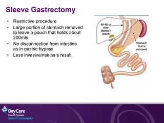 Sleeve Gastrectomy Restrictive procedure Large portion of stomach removed to leave a pouch that holds about 200mls No disconnection from intestine as in gastric bypass  Less invasive/risk as a result 