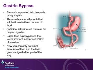 Gastric Bypass Stomach separated into two parts using staples This creates a small pouch that will hold two to three ounces of food Sufficient intestine still remains for proper digestion Eaten food now bypasses the lower stomach and about 100cm of intestine Now you can only eat small amounts of food and the food goes undigested for part of the way 