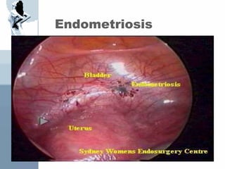 Endometriosis
 
