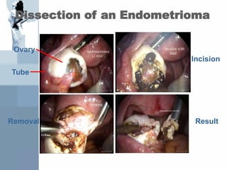 Dissection of an Endometrioma
Tube
Ovary
Incision
Removal Result
 