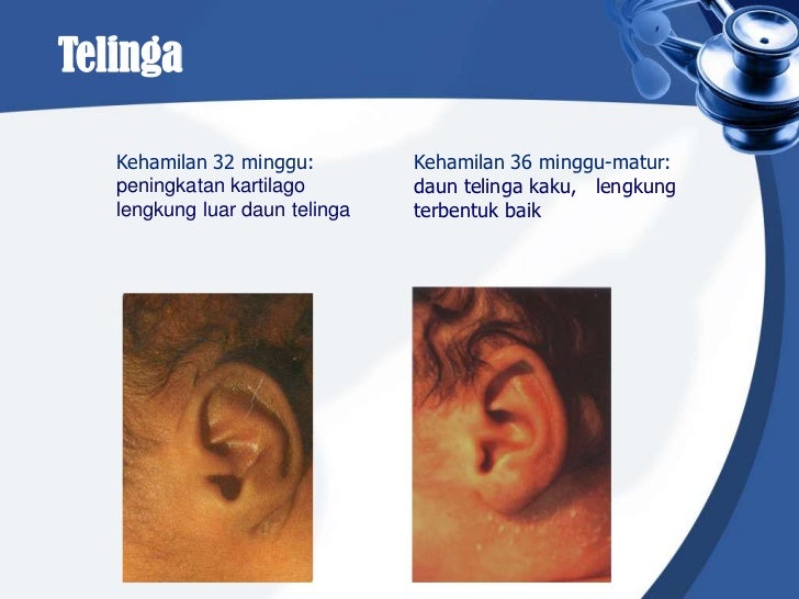 Bayi berat lahir rendah