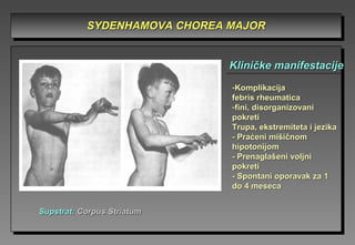 SYDENHAMSYDENHAMOVAOVA CHOREACHOREA MAJORMAJORSYDENHAMSYDENHAMOVAOVA CHOREACHOREA MAJORMAJOR
-KomplikacijaKomplikacija
febris rheumaticafebris rheumatica
-fini, disorganizovanifini, disorganizovani
pokretipokreti
Trupa, ekstremiteta i jezikaTrupa, ekstremiteta i jezika
-- Praćeni mišičnomPraćeni mišičnom
hipotonijomhipotonijom
-- Prenaglašeni voljniPrenaglašeni voljni
pokretipokreti
-- Spontani oporavak za 1Spontani oporavak za 1
do 4 mesecado 4 meseca
Kliničke manifestacijeKliničke manifestacije
SupstratSupstrat:: Corpus StriatumCorpus Striatum
 
