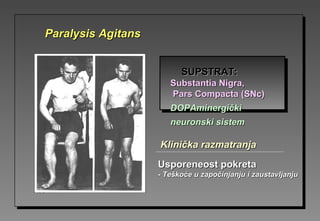 SUPSTRAT:SUPSTRAT:
Substantia Nigra,Substantia Nigra,
Pars Compacta (SNc)Pars Compacta (SNc)
DOPAminergiDOPAminergičkički
nneuroneuronski sistemski sistem
Usporeneost pokretaUsporeneost pokreta
-- Teškoće u započinjanju i zaustavljanjuTeškoće u započinjanju i zaustavljanju
Klinička razmatranjaKlinička razmatranja
Paralysis AgitansParalysis Agitans
 