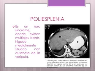 POLIESPLENIA
 Es

un
raro
sindrome,
donde existen
multiples bazos,
higado
medialmente
situado,
con
ausencia de la
vesicula.
La tomografía computarizada abdominal muestra una
aorta a la derecha (a), una vena ácigos agrandada
(flecha), un hígado central (H) y un estómago en
posición normal (E). Las estructuras redondas (B) son
múltiples bazos.

 