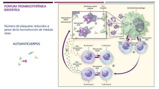 PÚRPURA TROMBOCITOPÉNICA
IDIOPÁTICA
Número de plaquetas reducidos a
pesar de la normofunción de médula
ósea.
AUTOANTICUERPOS
 