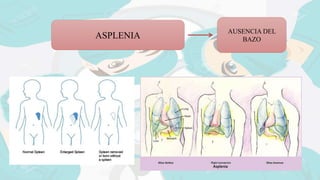 ASPLENIA
AUSENCIA DEL
BAZO
 