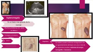 Esplenomegalia
Es un bazo mas grande de lo
normal.
Muchos problemas de salud
se debe a: :
Enfermedades de
la sangre o el sistema
linfático
InfeccionesCáncer
Enfermedad hepática
Diagnóstico
Su médico puede confirmar el diagnóstico de
un agrandamiento del bazo con una o más de
las siguientes pruebas: exámenes de sangre,
tomografía o resonancia.
 