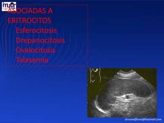ASOCIADAS A
ERITROCITOS
Esferocitosis
Drepanocitosis
Ovalocitosis
Talasemia
Romel
 