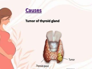 Causes
Tumor of thyroid gland