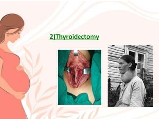 2)Thyroidectomy