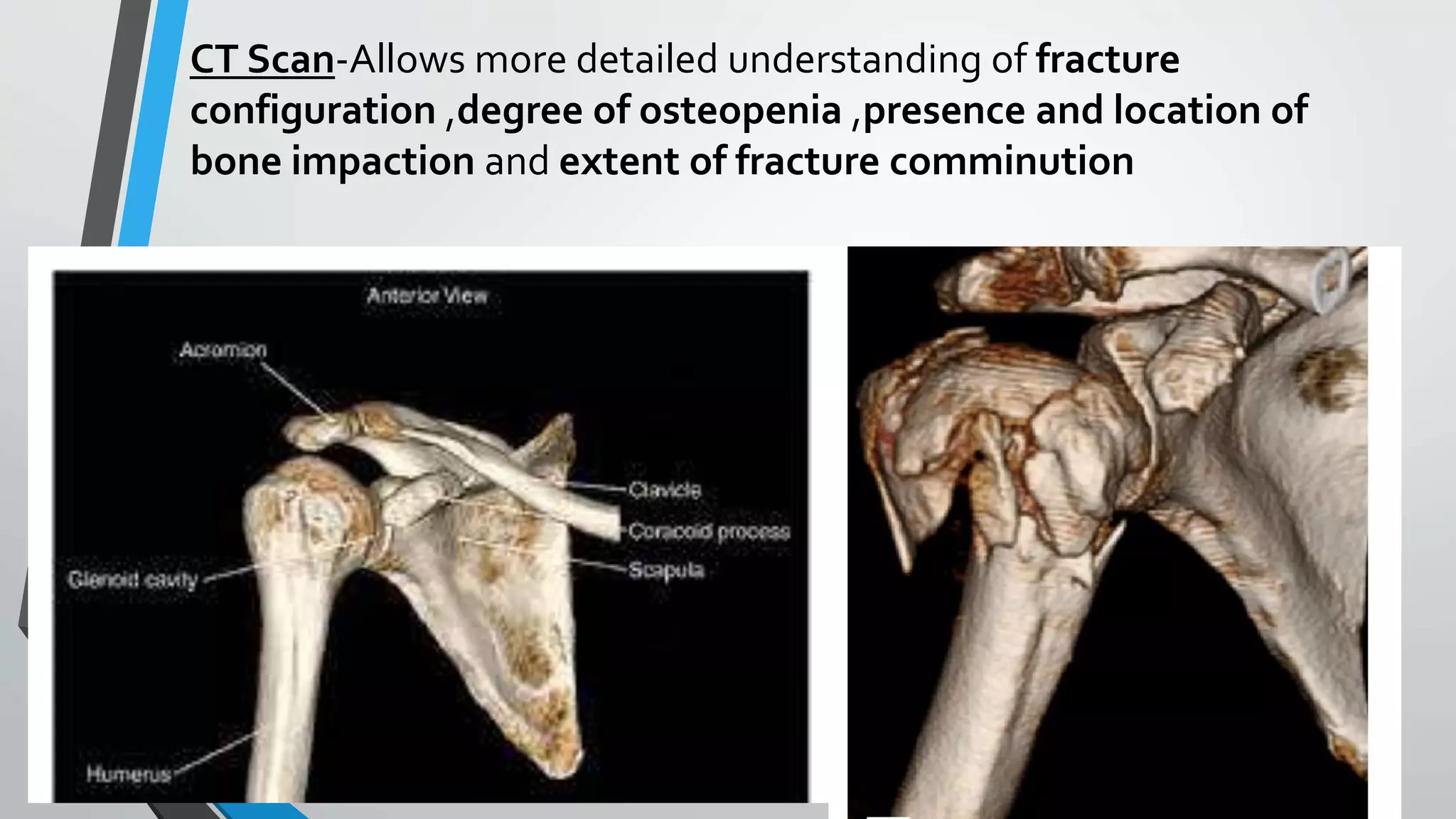 CT Scan-Allows more detailed understanding of fracture
configuration ,degree of osteopenia ,presence and location of
bone impaction and extent of fracture comminution
 