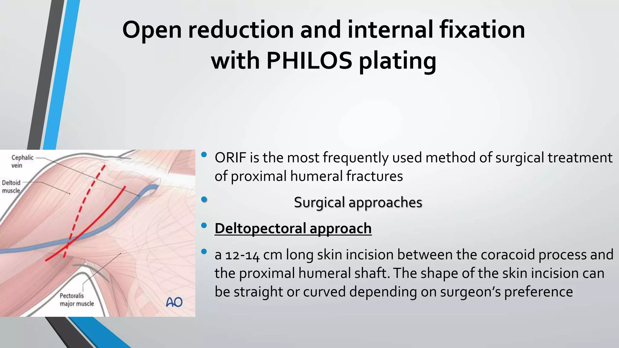 Open reduction and internal fixation
with PHILOS plating
• ORIF is the most frequently used method of surgical treatment
of proximal humeral fractures
• Surgical approaches
• Deltopectoral approach
• a 12-14 cm long skin incision between the coracoid process and
the proximal humeral shaft.The shape of the skin incision can
be straight or curved depending on surgeon’s preference
 