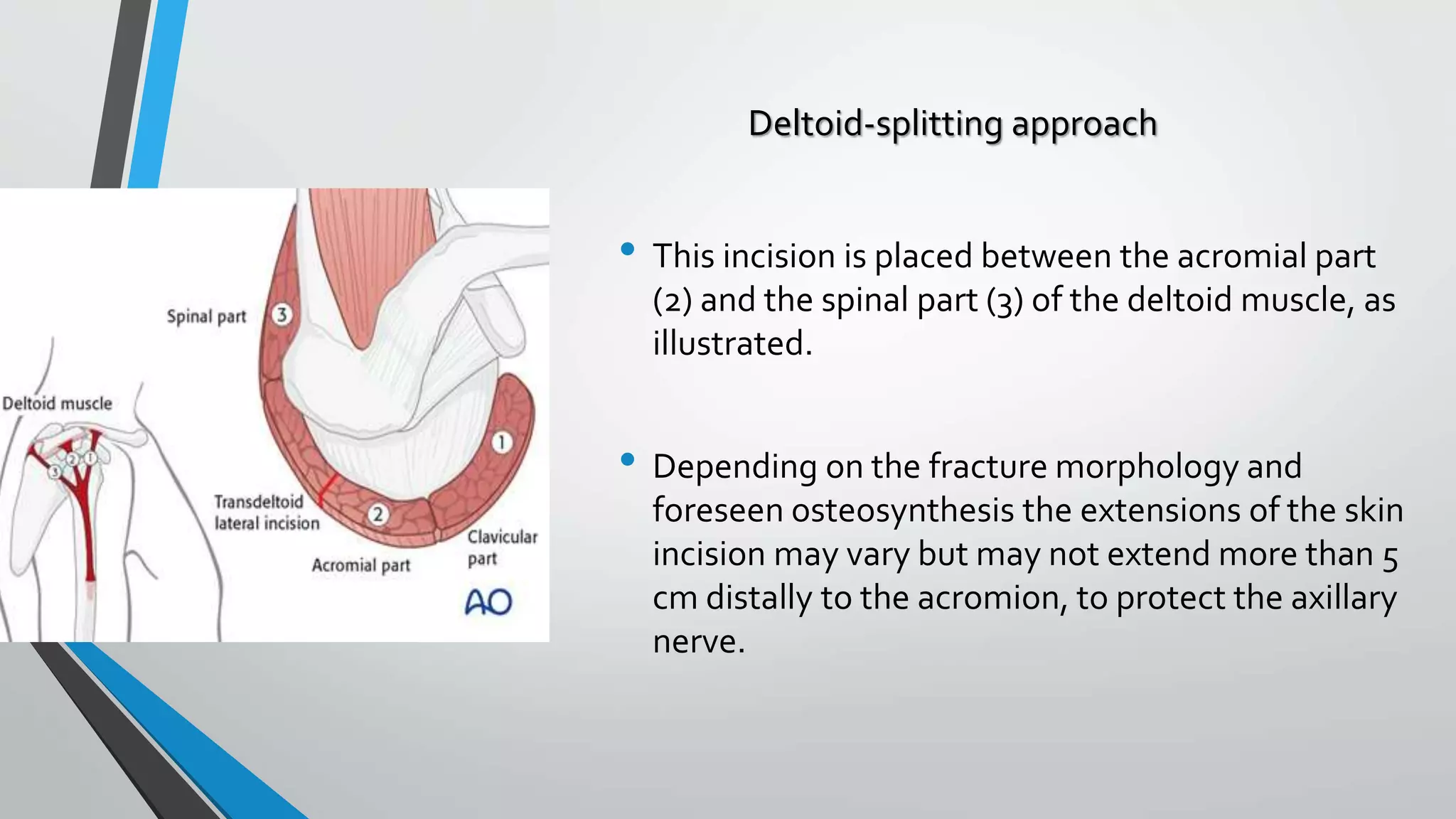 Deltoid-splitting approach
• This incision is placed between the acromial part
(2) and the spinal part (3) of the deltoid muscle, as
illustrated.
• Depending on the fracture morphology and
foreseen osteosynthesis the extensions of the skin
incision may vary but may not extend more than 5
cm distally to the acromion, to protect the axillary
nerve.
 