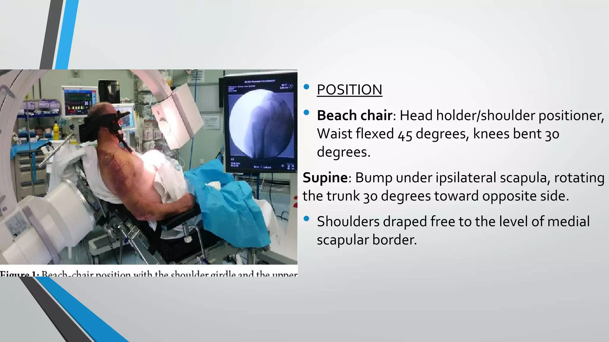 • POSITION
• Beach chair: Head holder/shoulder positioner,
Waist flexed 45 degrees, knees bent 30
degrees.
Supine: Bump under ipsilateral scapula, rotating
the trunk 30 degrees toward opposite side.
• Shoulders draped free to the level of medial
scapular border.
 