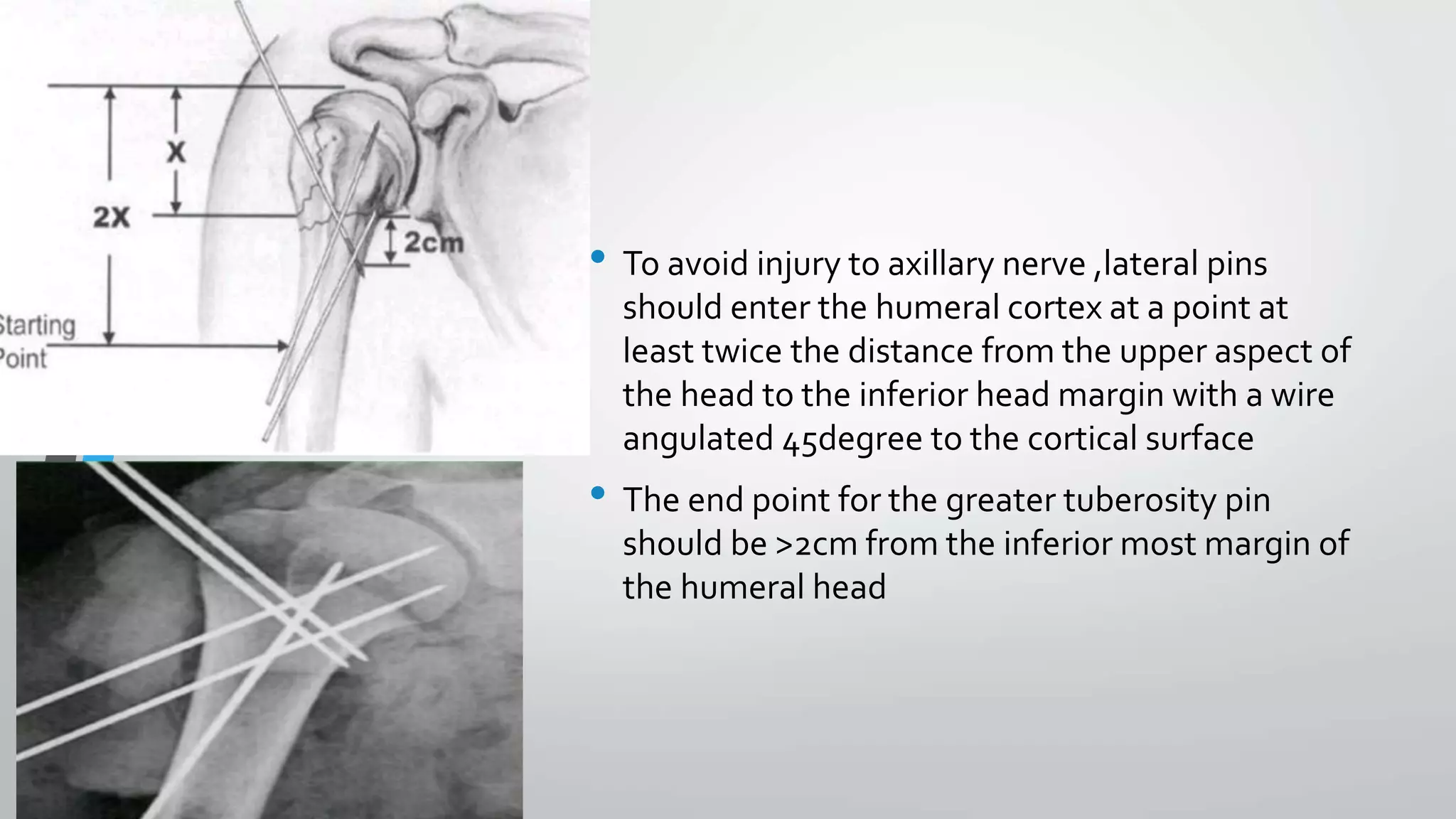 • To avoid injury to axillary nerve ,lateral pins
should enter the humeral cortex at a point at
least twice the distance from the upper aspect of
the head to the inferior head margin with a wire
angulated 45degree to the cortical surface
• The end point for the greater tuberosity pin
should be >2cm from the inferior most margin of
the humeral head
 