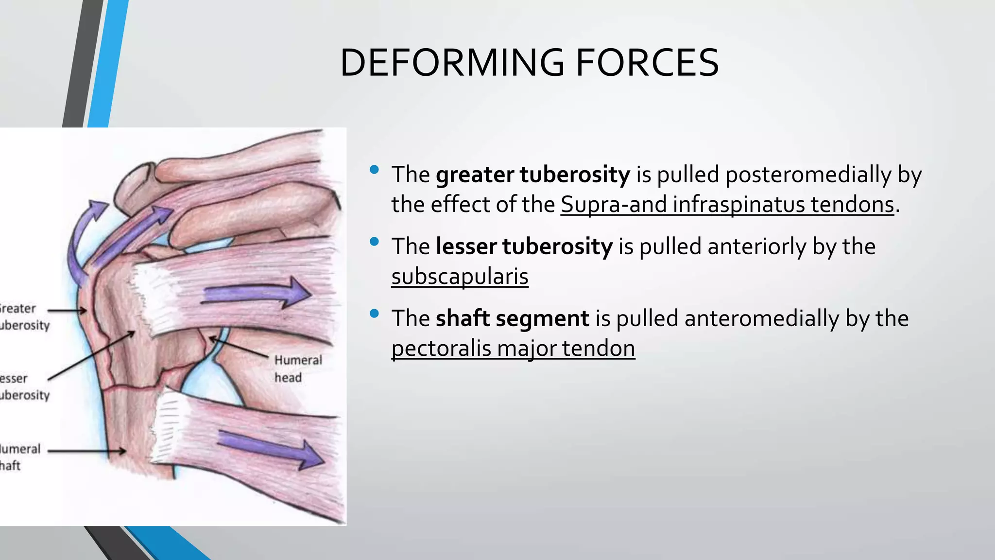 DEFORMING FORCES
• The greater tuberosity is pulled posteromedially by
the effect of the Supra-and infraspinatus tendons.
• The lesser tuberosity is pulled anteriorly by the
subscapularis
• The shaft segment is pulled anteromedially by the
pectoralis major tendon
 